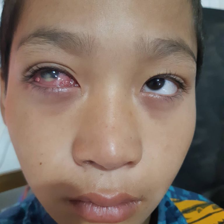 ताप्लेजुङमा सापुको समस्या बढ्दो,सेतो पुतलीको संसर्गबाट टाढै रहन विज्ञको सल्लाह
